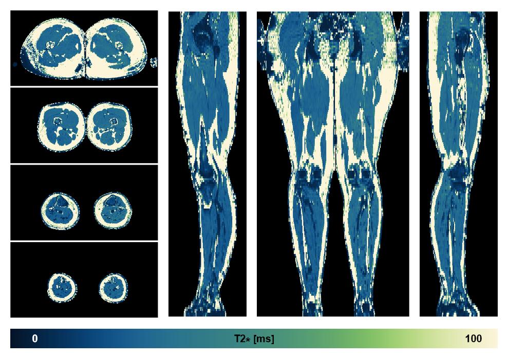 The T2 star relaxation time of the lower extremity obtained from the dixon reconstruction for muscle water fat quantification.